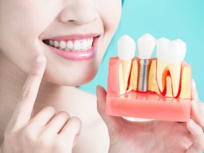 Giá Trồng Răng Ở Vinh Nghệ An Bao Nhiêu? Cấy Ghép Implant Có Đau Không?