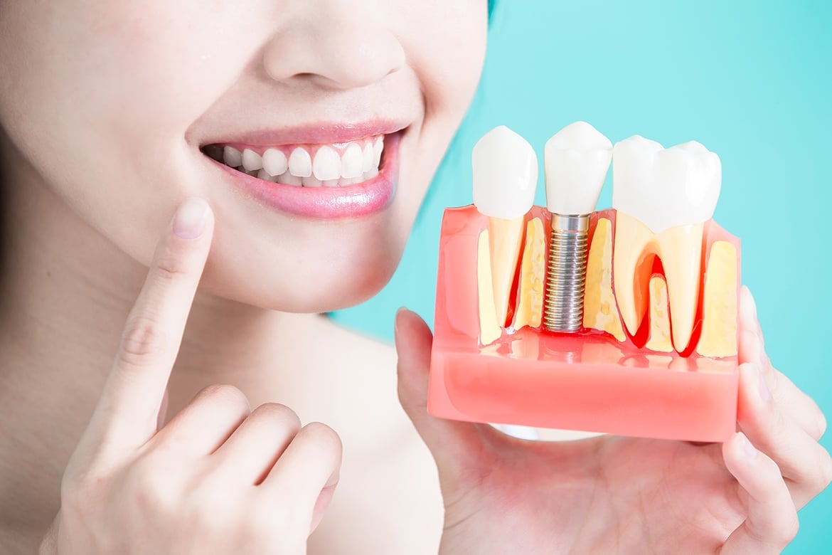 Giá Trồng Răng Ở Vinh Nghệ An Bao Nhiêu? Cấy Ghép Implant Có Đau Không?