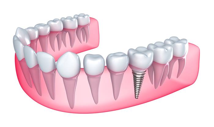 Giá Trồng Răng Ở Vinh Nghệ An Bao Nhiêu? Cấy Ghép Implant Có Đau Không? 3